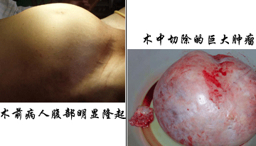 團隊作戰(zhàn),婦科手術(shù)賦新篇