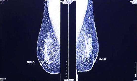 乳腺攝影的價(jià)值解讀